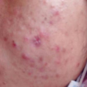 LEFW Acne Treatment untuk kulit berjerawat