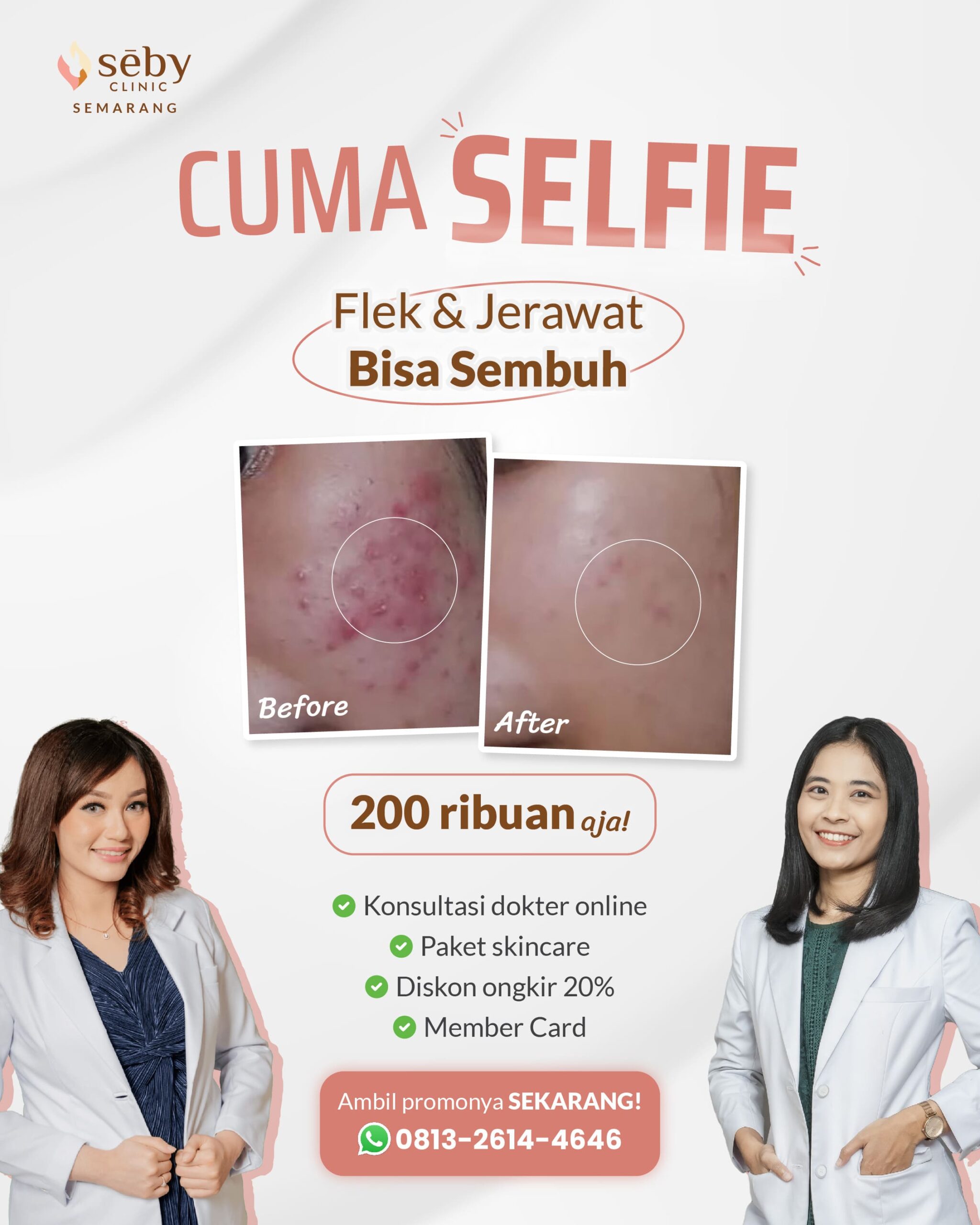 Promo Konsultasi Online Flek dan Jerawat