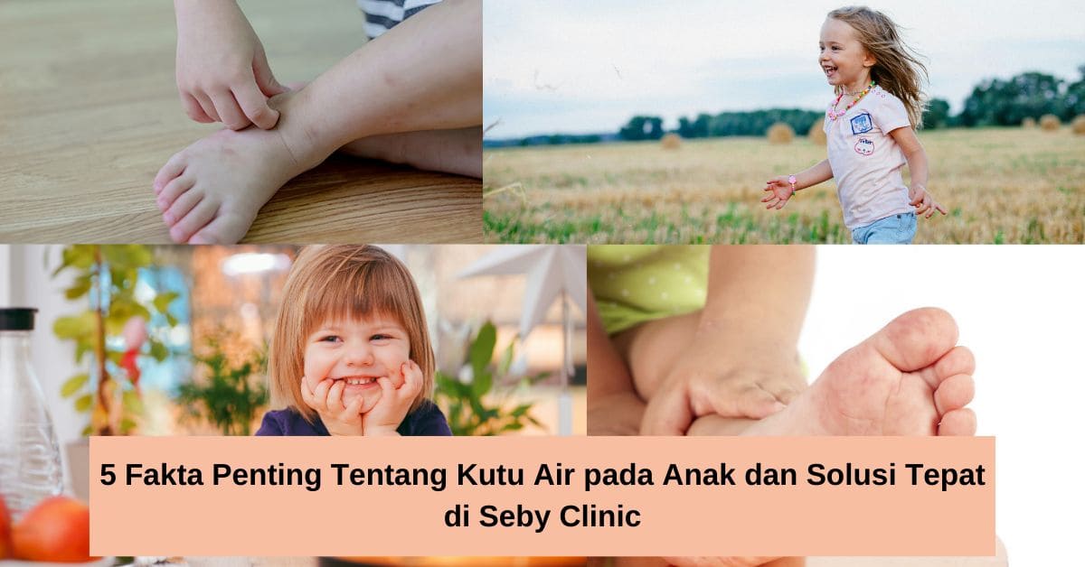 5 Fakta Penting Tentang Kutu Air pada Anak dan Solusi Tepat di Seby Clinic