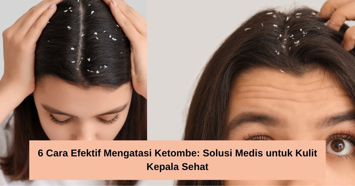 6 Cara Efektif Mengatasi Ketombe Solusi Medis untuk Kulit Kepala Sehat