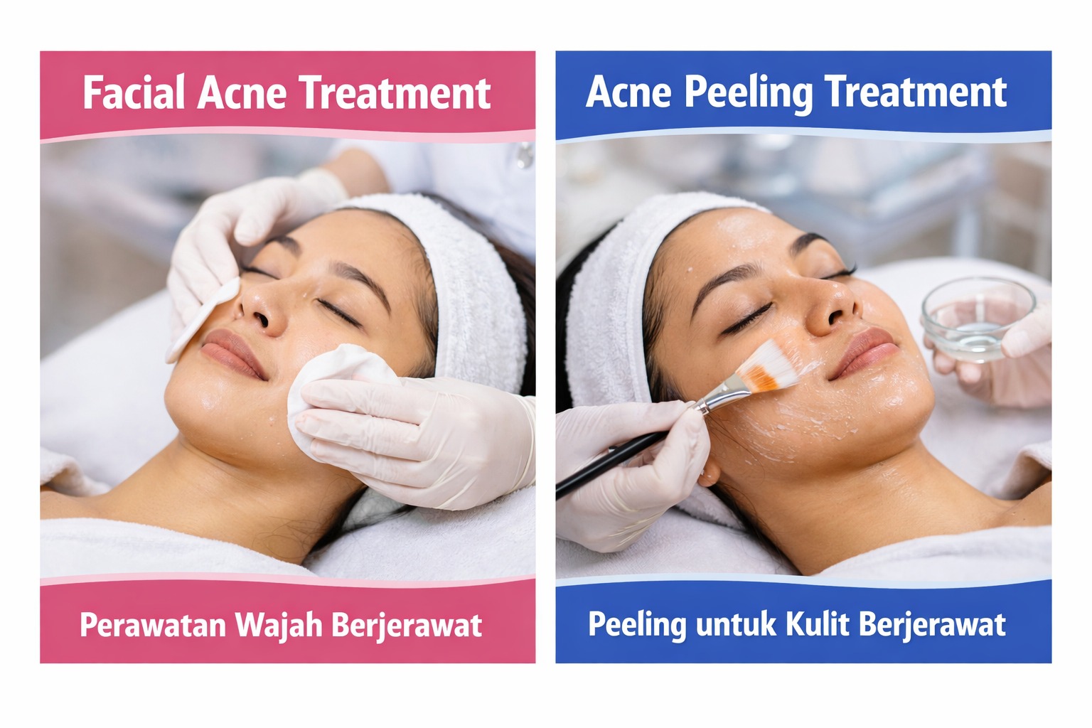 treatment untuk kulit berjerawat