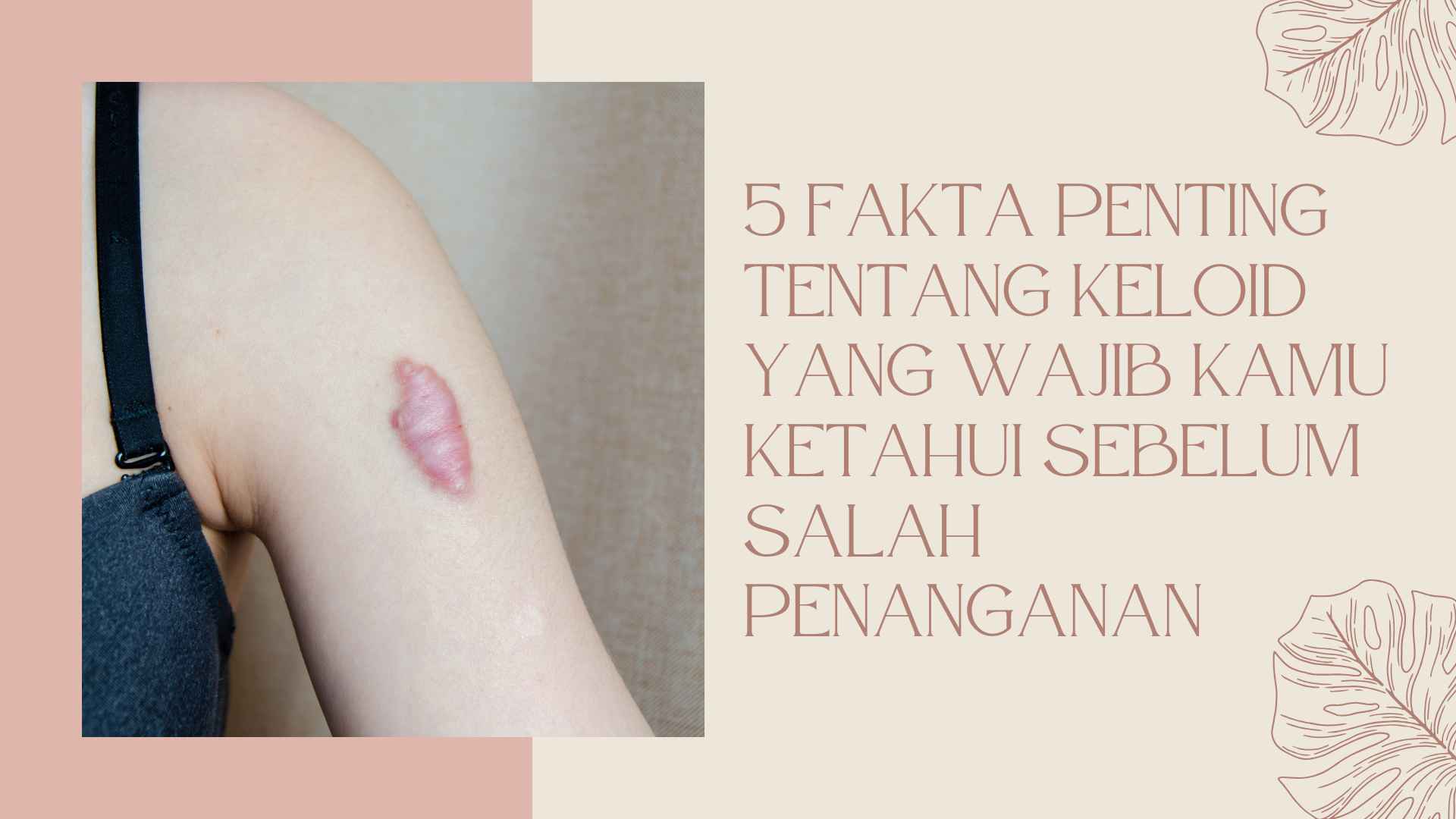 5 Fakta Penting Tentang Keloid yang Wajib Kamu Ketahui Sebelum Salah Penanganan