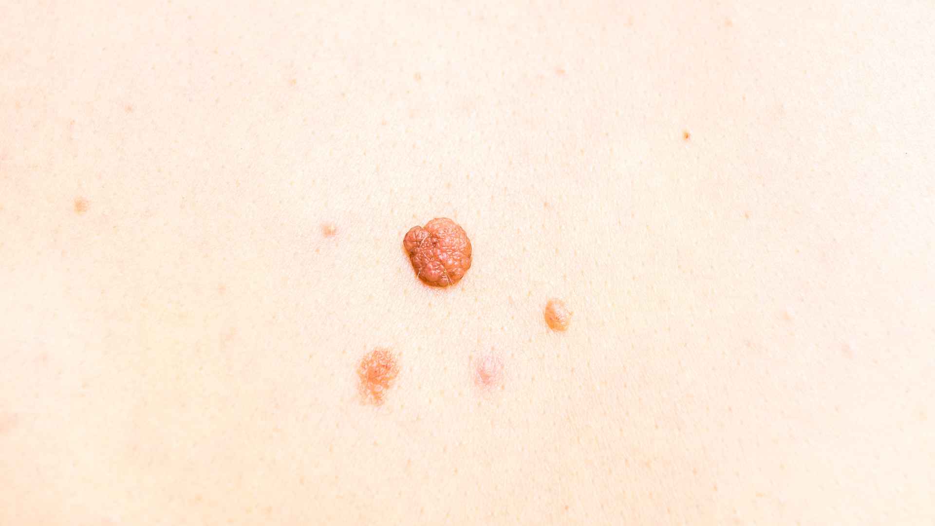 skintag