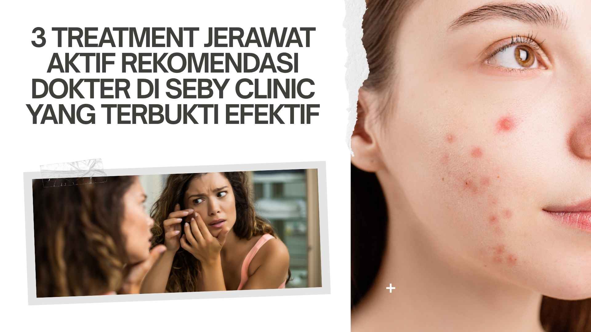 3 Treatment Jerawat Aktif Rekomendasi Dokter di Seby Clinic yang Terbukti Efektif