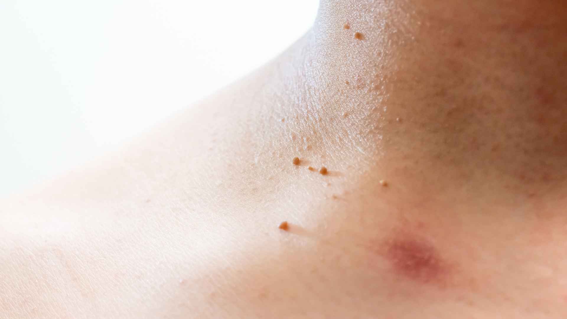 skintag