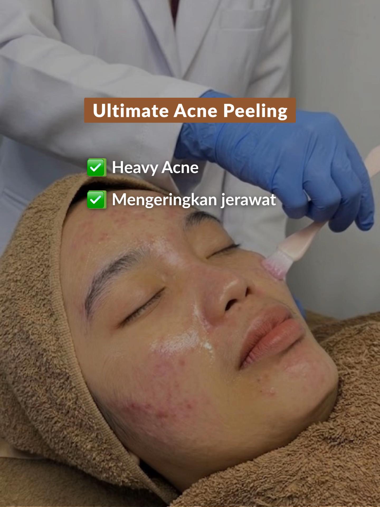 Ultimate Acne Peeling