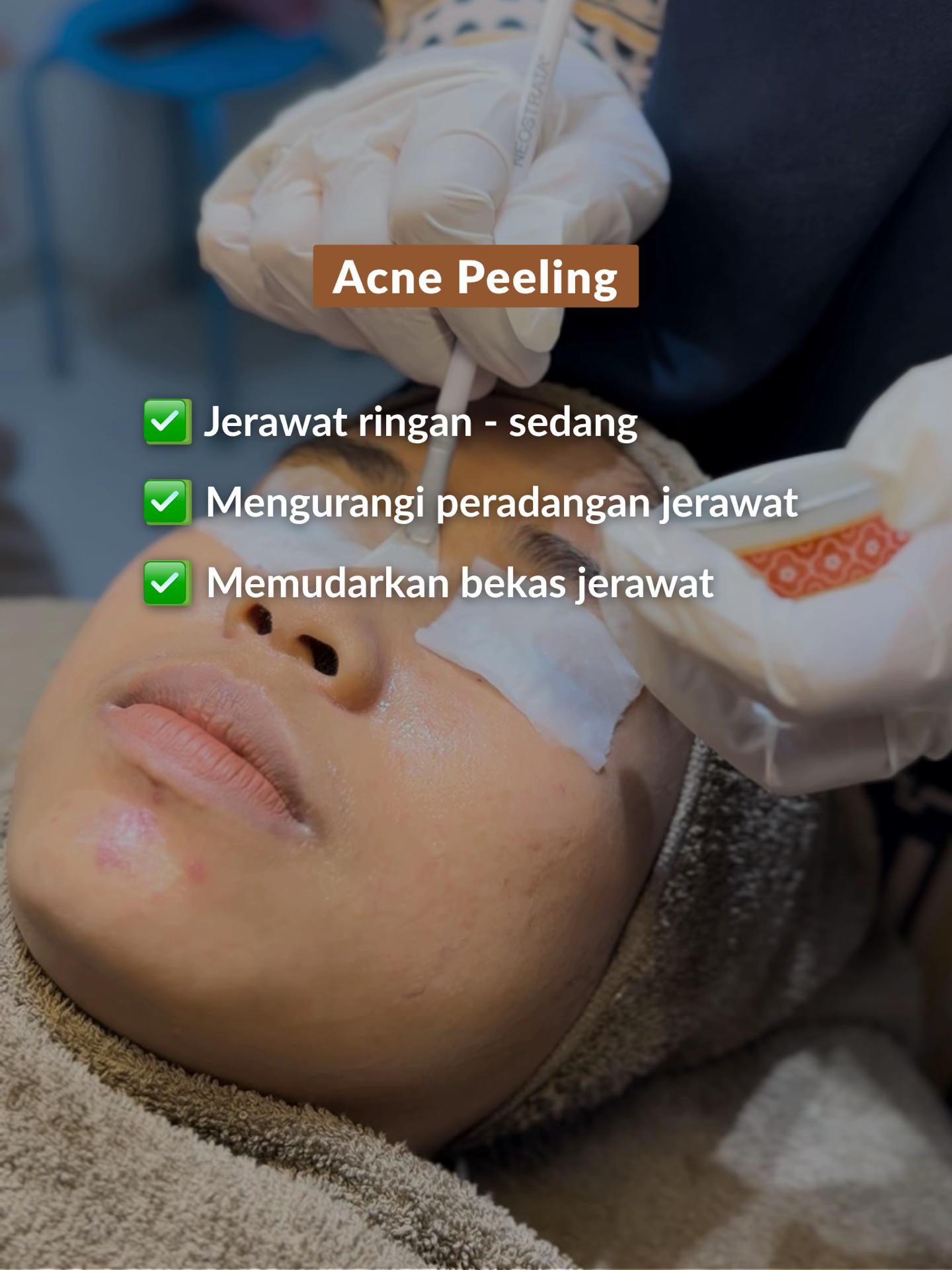 Acne Peeling