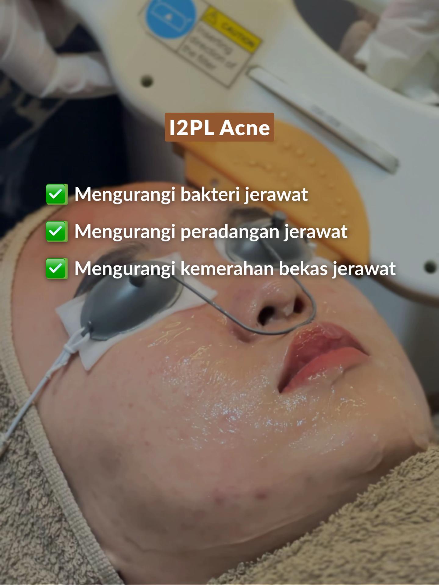 I2PL Acne